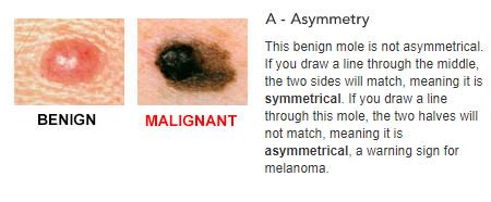 SkinCancerOrg's tweet photo. If you draw a line through a mole &amp; the 2 halves don't match, it is asymmetrical. Asymmetry = melanoma warning sign. https://t.co/6KI8k1QRV5 https://t.co/yDum4R3IO1