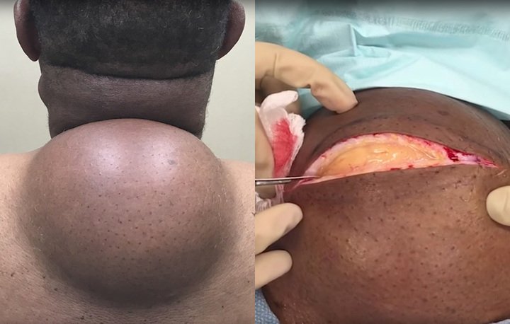 WomensHealthMag's tweet photo. This bowling-ball sized cyst totally tops all pimple-popping videos out there: https://t.co/77F2DyqzM7 https://t.co/L78uOabngP