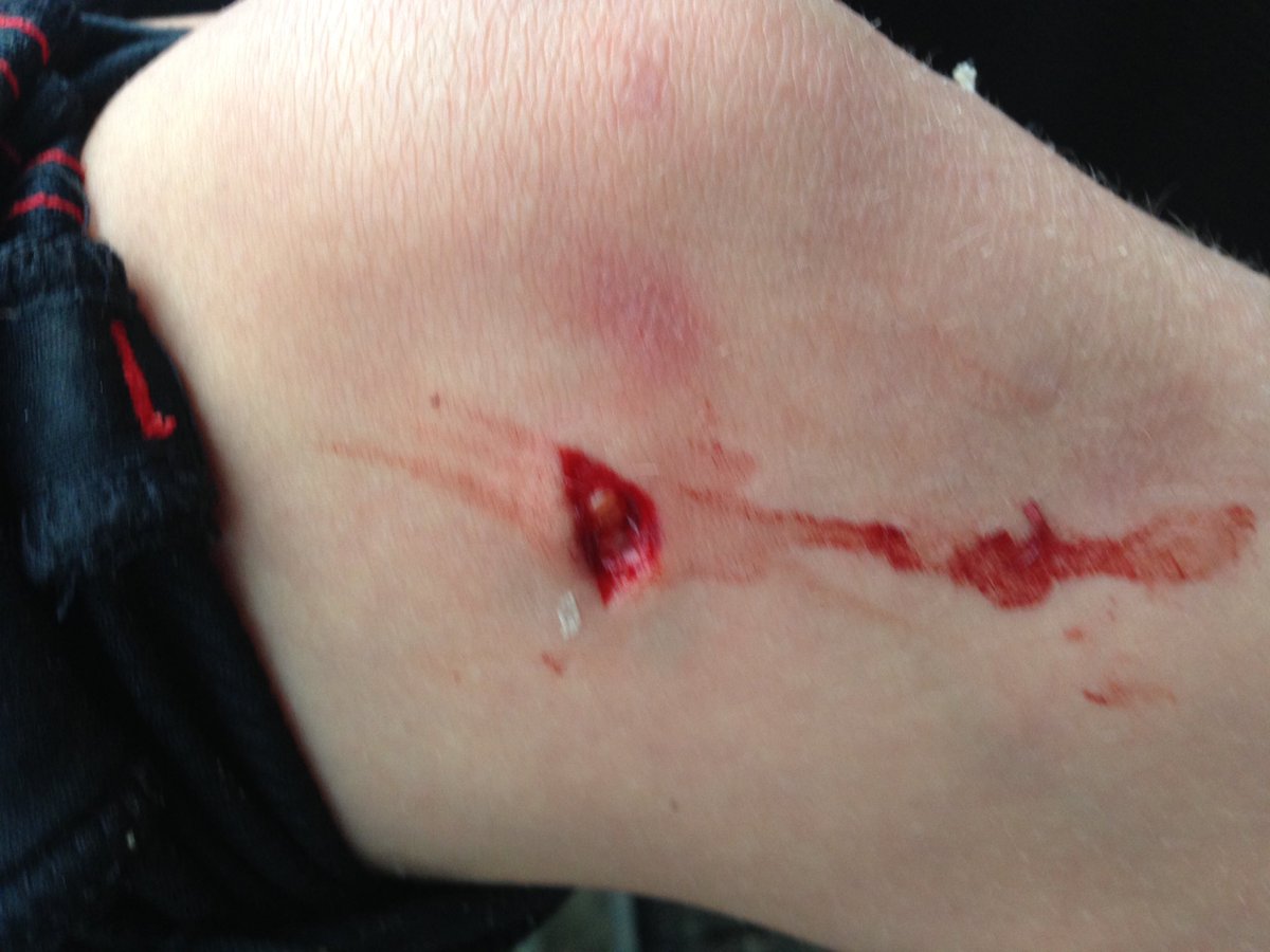 vikingchewie's tweet photo. When a knee meets a motorcycle chain. #dirtbikes https://t.co/6uCUfSUArr