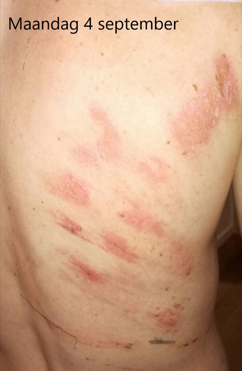 EFC_LR_VULSTEKE's tweet photo. Great results in 1 week time! Thanks @LRmedical for support!
#debrisoft #lomatuellpro #stellaline #suprasorbF https://t.co/2SATDwqxaE