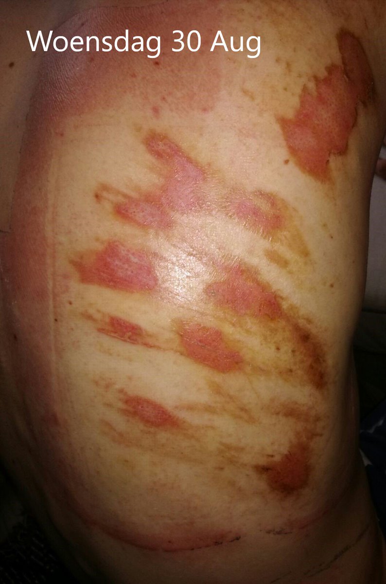 EFC_LR_VULSTEKE's tweet photo. Great results in 1 week time! Thanks @LRmedical for support!
#debrisoft #lomatuellpro #stellaline #suprasorbF https://t.co/2SATDwqxaE