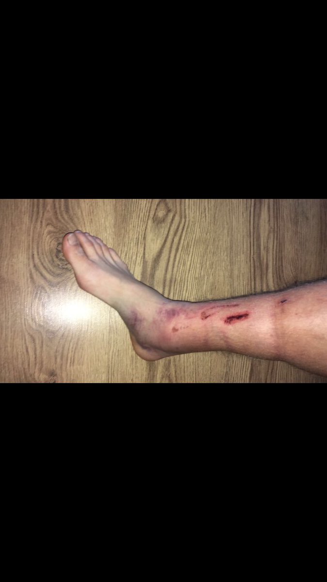 We got a dubious straight red card yesterday! Yet this is one of our players leg today! Not even a foul 🤦‍♂️