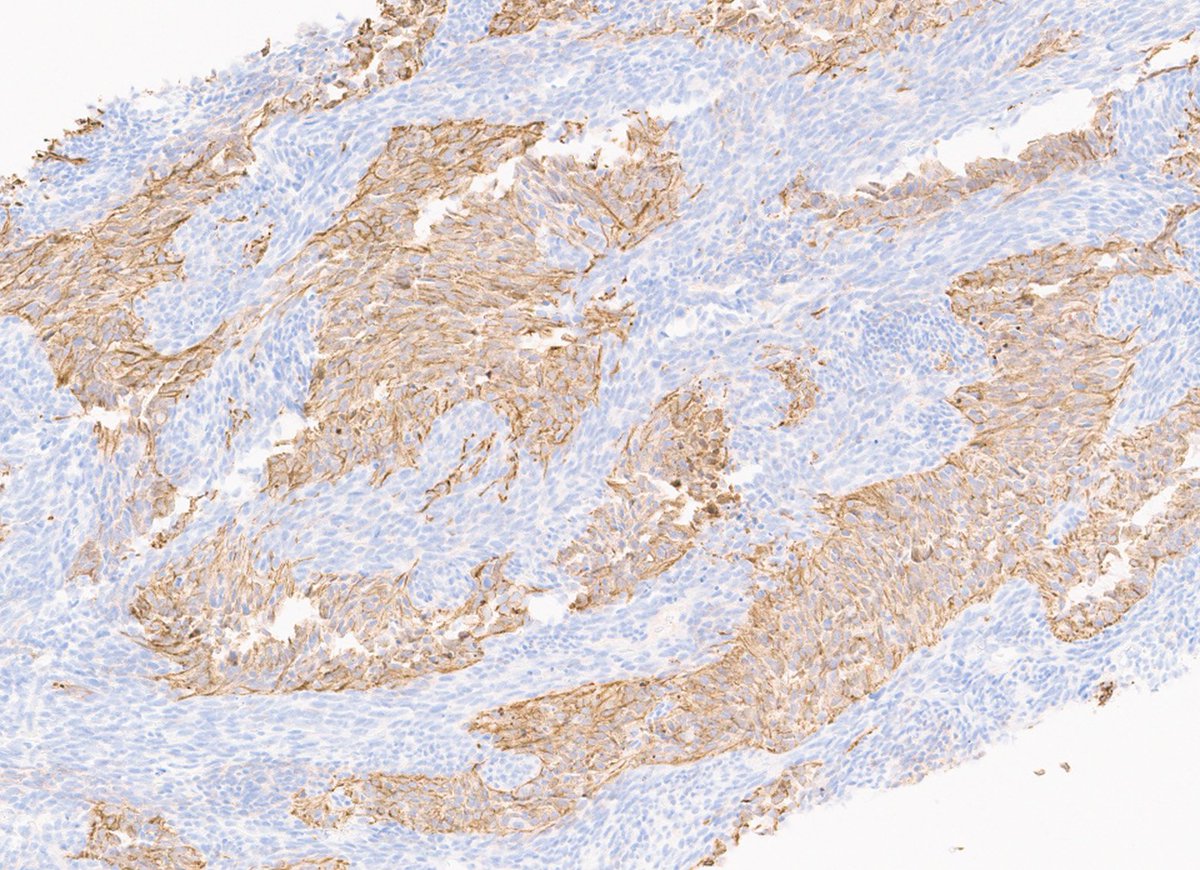 Flight get delayed for 8h, so here is a case for entertainment: 10cm anterior mediastinal mass in a 50M. #pulmpath #guessognosis DX &amp; IHCs
