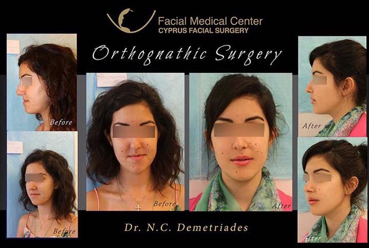 DemetriadesNeo's tweet photo. Who Needs Orthognathic / Corrective Jaw Surgery?
♦️More Info: https://t.co/Y1sHlL3pFj
.
#cyprusfacialsurgery #oralandmaxillofacialsurgery https://t.co/cEsNuZPXNr