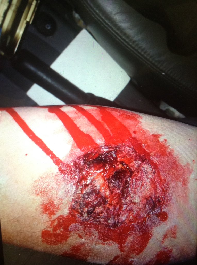 I've done millions of zombie bites but this one is my favourite. What do you think??? #specialfxmakeup #specialfxartist #thewalkingdead #amc
