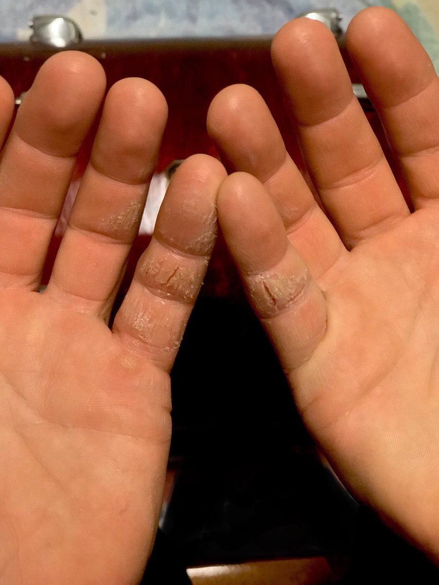 ebbertgepner's tweet photo. Playing 3 shifts =‘s 12 hrs straight yesterday! Thnk god 4 liquid bandage 🤕
#ebbertgepner #nashvilledrummer #nashvillehonkeytonk #broadlife https://t.co/D2kEk8EPrG