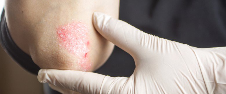 hdassurances's tweet photo. Journée mondiale du psoriasis : une campagne pour sensibiliser le grand public #journeemondialedupsoriasis https://t.co/906oKUaqcw https://t.co/wzeOC7pFvN