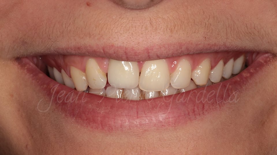 SDM2017Bulgaria's tweet photo. View clinical case by Dr. Jean-Pierre Gardella !
Learn how to receive this result during Sofia Dental Meeting 2017 https://t.co/OLdtYzAMbo