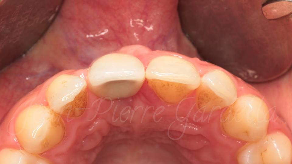 SDM2017Bulgaria's tweet photo. View clinical case by Dr. Jean-Pierre Gardella !
Learn how to receive this result during Sofia Dental Meeting 2017 https://t.co/OLdtYzAMbo
