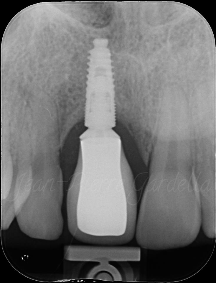 SDM2017Bulgaria's tweet photo. View clinical case by Dr. Jean-Pierre Gardella !
Learn how to receive this result during Sofia Dental Meeting 2017 https://t.co/OLdtYzAMbo