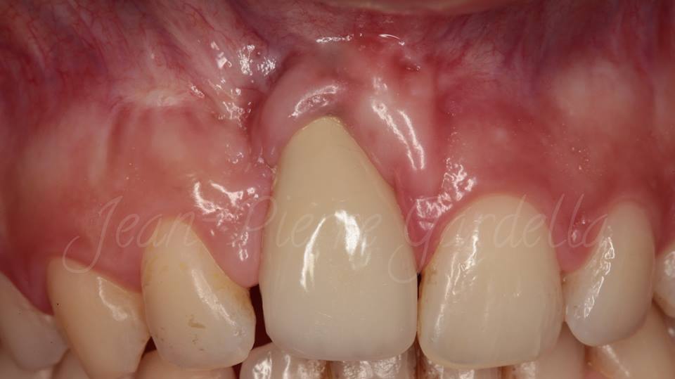 SDM2017Bulgaria's tweet photo. View clinical case by Dr. Jean-Pierre Gardella !
Learn how to receive this result during Sofia Dental Meeting 2017 https://t.co/OLdtYzAMbo