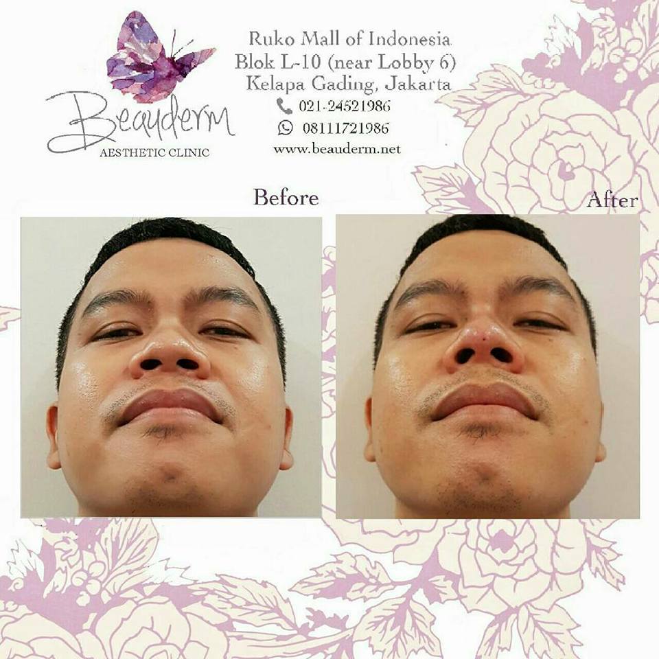 Harga Filler Hidung Di Jakarta Aesthetic Clinic Harga Filler Hidung Di Jakarta Aesthetic Clinic