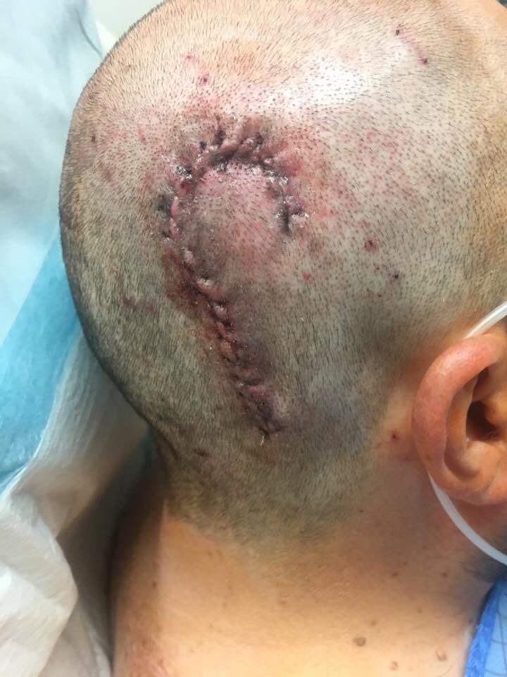 BryantGarvin's tweet photo. Kids say my scar from #brainsurgery looks like Maui's fishhook

@TheRock what do you think?

Think we should hang in person?

#ThatWouldRock https://t.co/KlLe3zCk7W