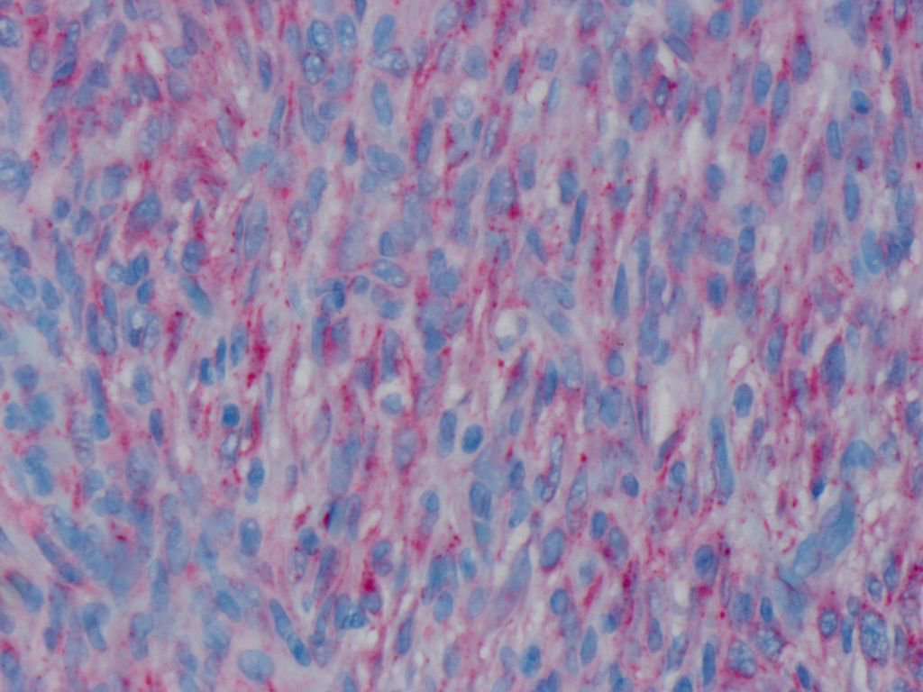 Cellular Neurothekeoma: dermal neoplasm unclear histogenesis, histologically varied: nested, sheet like or myxoid.NKIC3 usually+ #Dermpath