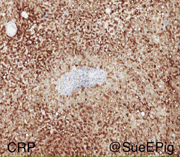 Telangiectatic variant of hepatocellular adenoma, gross and microscopic correlation #liverpath #hhpath #amyloida #CRP