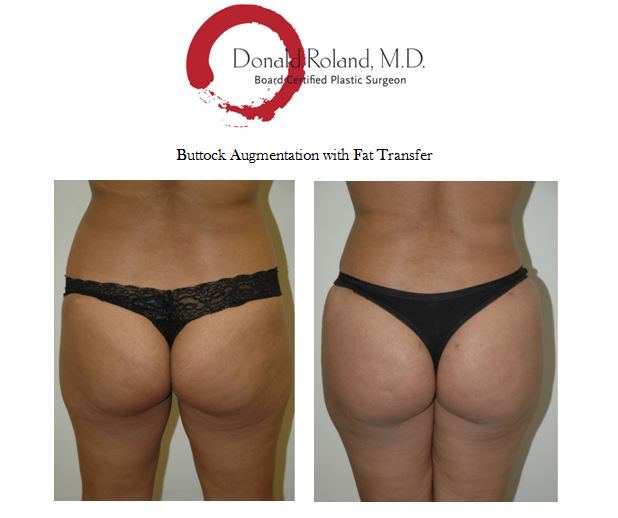 DRolandMD's tweet photo. This 30 year old patient underwent a Buttock Augmentation with fat transfer. #Brazilianbuttlift #bbl #buttaugmentation #glutes https://t.co/1HRPlda4SM