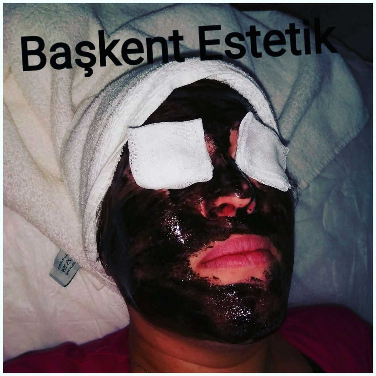 #başkentestetik #ciltbakımı #güzellik #estetik #gençlik #kadın #erkek #yaz #kampanya #indirim #women #men #maske #ankara #ankarastyles