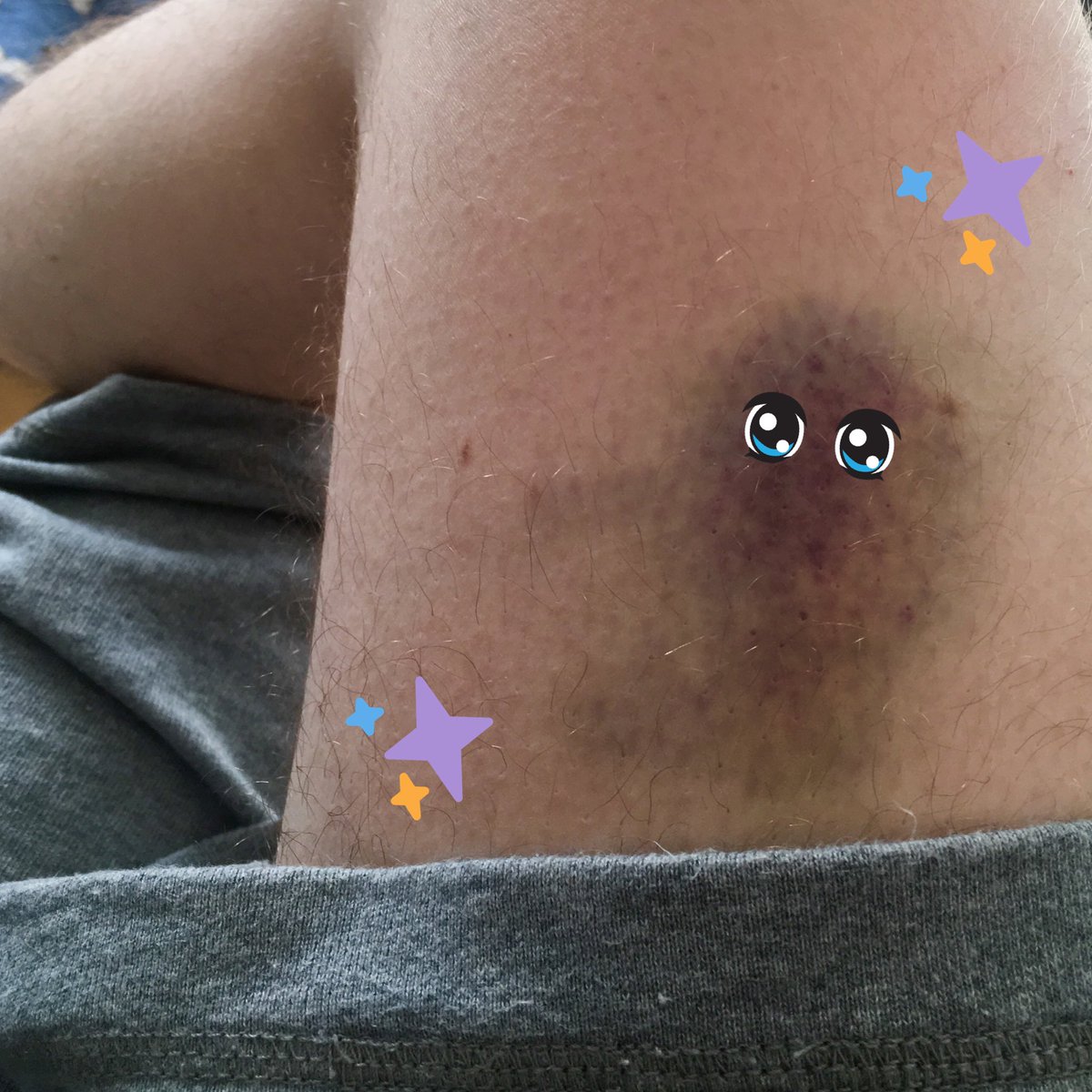 AmazingPhil's tweet photo. I got a huge bruise on my leg and I'm trying to figure out if it looks like a screaming duck or a sloth holding onto a tree https://t.co/1ur0pAFVDa