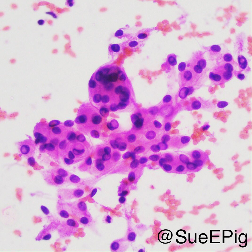 SueEPig's tweet photo. Whorls, intranuclear inclusions common, may contain psammoma bodies #meningioma #neuropath  #braintumor #hhpath #touchprep #pathology https://t.co/Uznqw9ev73