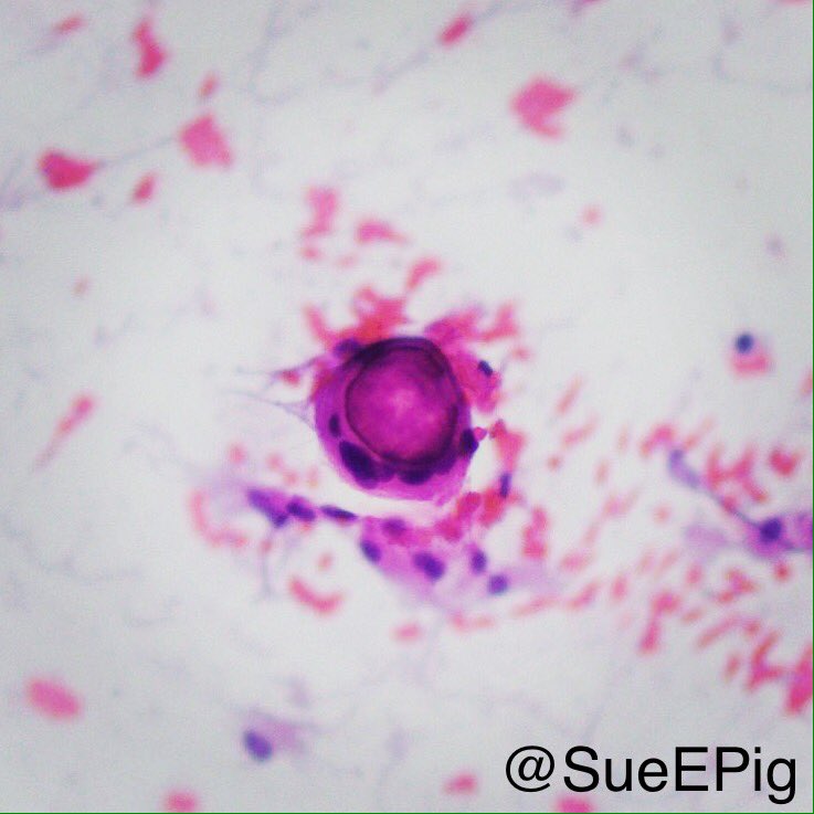 Whorls, intranuclear inclusions common, may contain psammoma bodies #meningioma #neuropath  #braintumor #hhpath #touchprep #pathology
