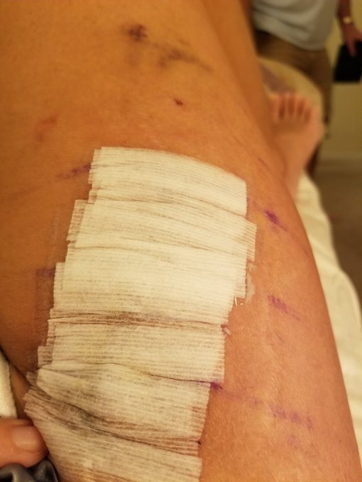 Swelling is way down and they took off the big bandage!! Making progress!! https://t.co/RPOloqIURH
