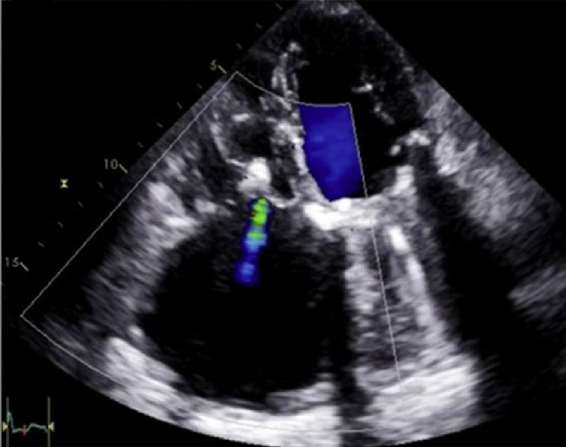 RevEspCardiol's tweet photo. Reparación transcatéter de tricúspide con MitraClip en paciente con anuloplastia de De Vega fallida #AheadOfPrint https://t.co/bprjXOEhvN https://t.co/Jw2OY1uELO