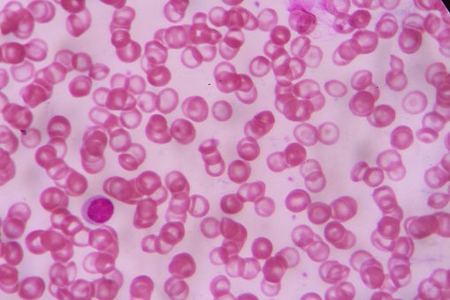 wusa9's tweet photo. FDA approves treatment for sickle cell disease, Newborn Screening Awareness Month https://t.co/QmWwvMERqf https://t.co/qqldYeM7VP
