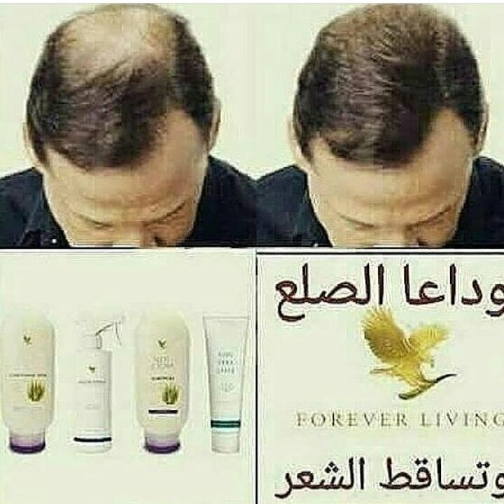 4everComp's tweet image. وداعا للصلع .. وفراغات الشعر للطلب او الاستفسار يرجى التواصل لدينا عبر الخاص