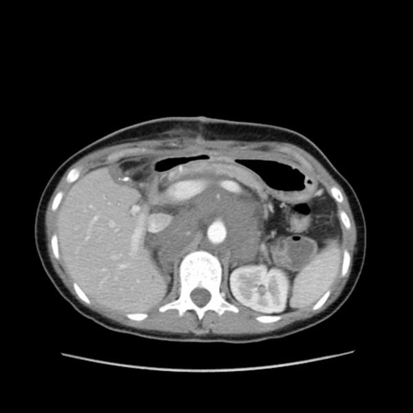 oncologicainfo's tweet photo. Ganglioneuroma: entenda um pouco https://t.co/aBWsSI9TBl https://t.co/Y7e0TS1GJn