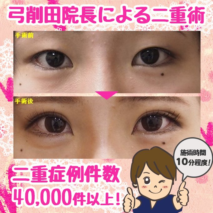 公式 東京形成美容外科 船橋本院 En Twitter パッチリ二重になりたい方必見 8 31まで期間限定 二重埋没法 両目２点 38 000円が29 800円 詳しくはこちら T Co Be1gkihjwu 0800 080 2784 東京形成美容外科 二重埋没法 船橋 美容外科 弓削田