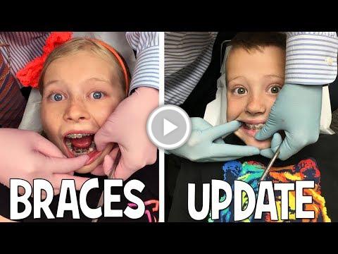 We Are Braces Twins!! vid.staged.com/Yg5u #mold #allergies #moldornot
