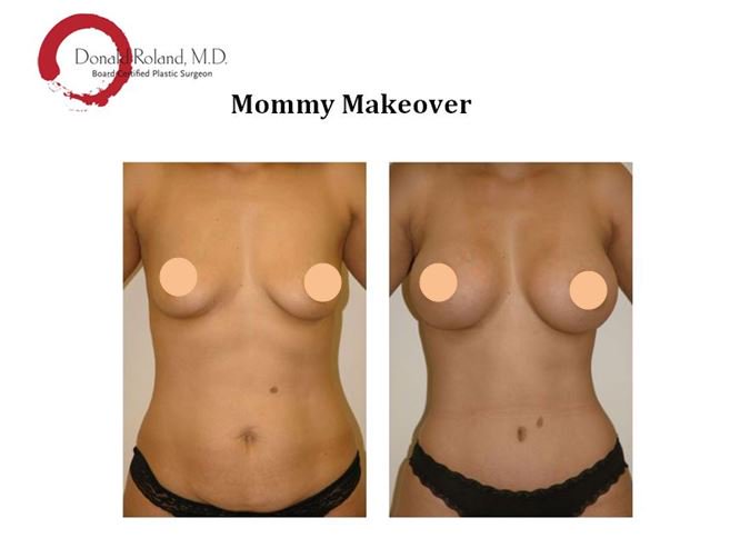 DRolandMD's tweet photo. Mommy Makeover - Before and After.  #mommymakeover #abdominoplastyandbreastaugmentation #tummytuckandbreastaugmentation #abdominoplasty https://t.co/bZmJAaA4NF