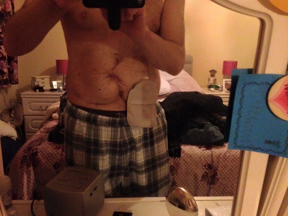 bakes1970's tweet photo. #GetYourBellyOut #TwitterTakeover #IBD #ostomy #stoma #ostomate #nocolonstillrollin https://t.co/8QZzAozFZn