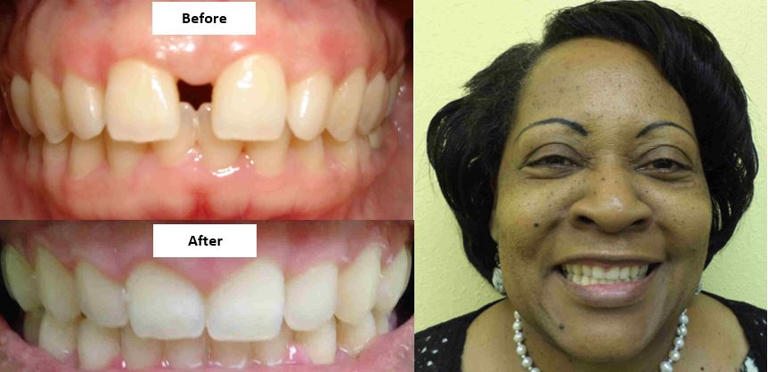 DrAnnaSmith's tweet photo. Have a gap?  Want it gone?  Fastbraces closed Glenda's gap in just one year!https://t.co/MngDinD68p https://t.co/ZTseDPEIom