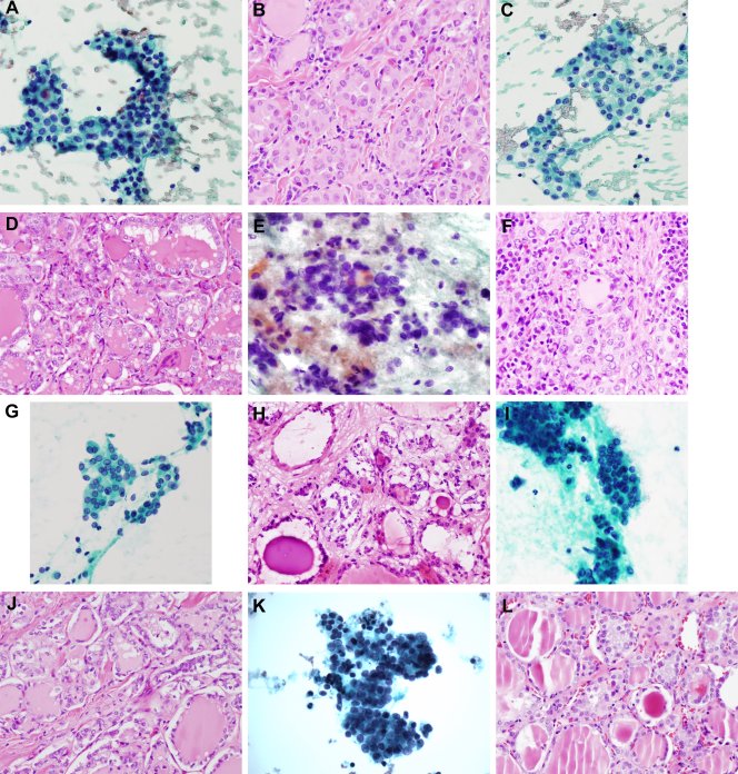 CancerCytopath's tweet photo. Features of noninvasive follicular thyroid neoplasm vs invasive forms of follicular variant of PTC https://t.co/W6SBn6Uxx6 https://t.co/WCLDO7vXXR