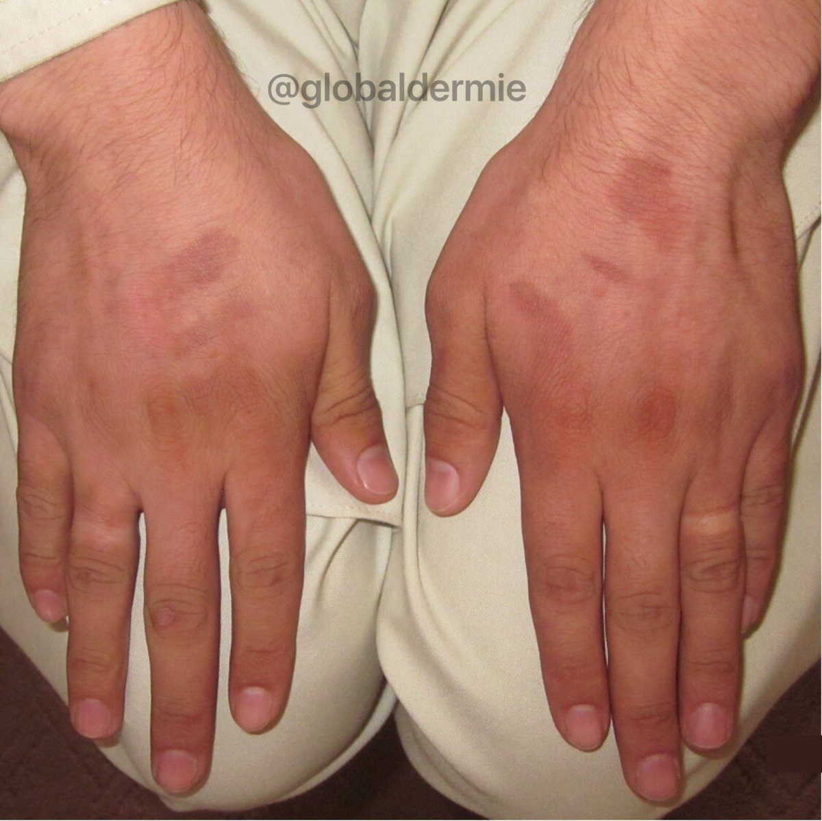 globaldermie's tweet photo. 25M x1wk. "I was outside cutting #lemons to make a juice drink last wk!” #phytophotodermatitis:phototoxic rxn-#furocoumarins+sun #globalderm https://t.co/LoGvIotlIb