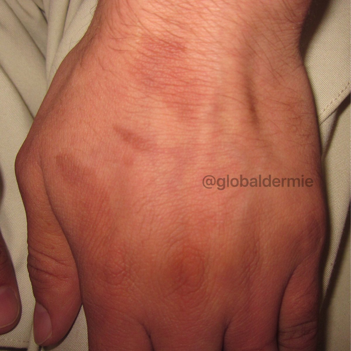 globaldermie's tweet photo. 25M x1wk. "I was outside cutting #lemons to make a juice drink last wk!” #phytophotodermatitis:phototoxic rxn-#furocoumarins+sun #globalderm https://t.co/LoGvIotlIb
