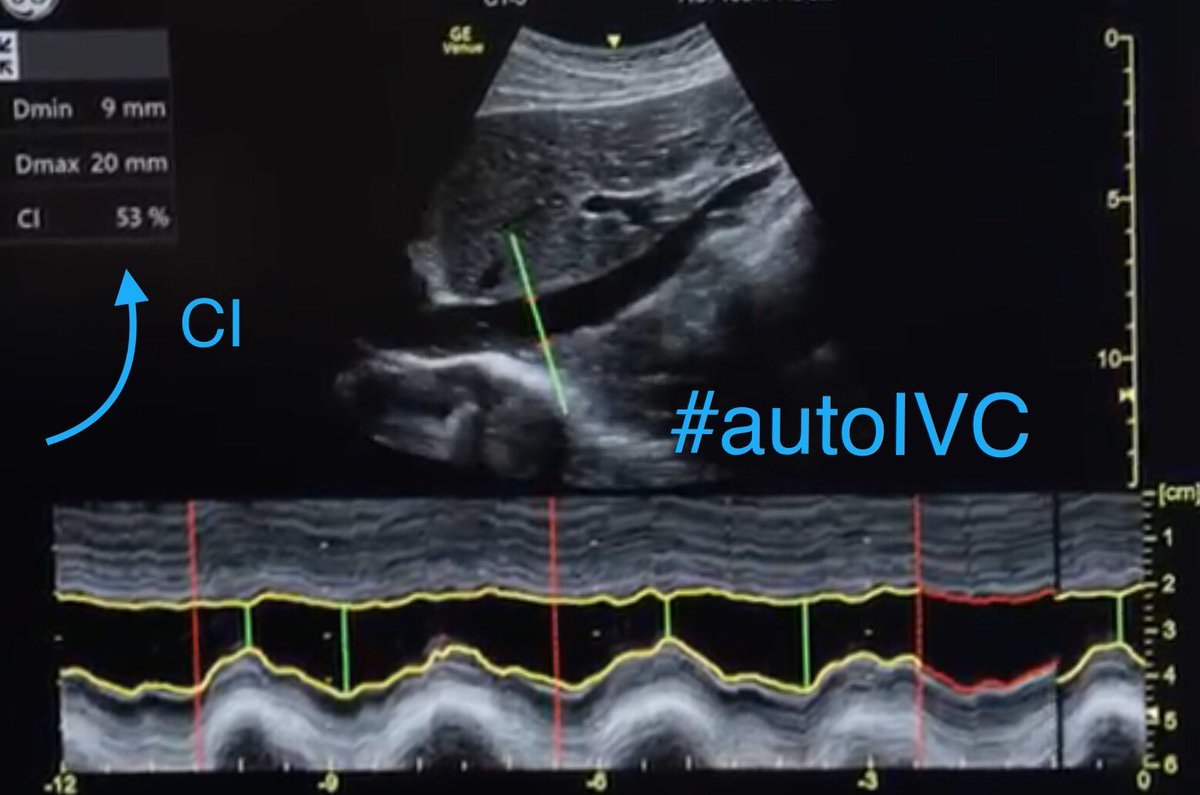 Lisa_Marlowe1's tweet photo. IVC collapsibility index made EASY! 😲😱😎
#autoIVC #shock #GEVenue #POCUS #emergencymedicine #criticalcare
https://t.co/ieJQj2qAa1 https://t.co/Z2f2m1oKvB