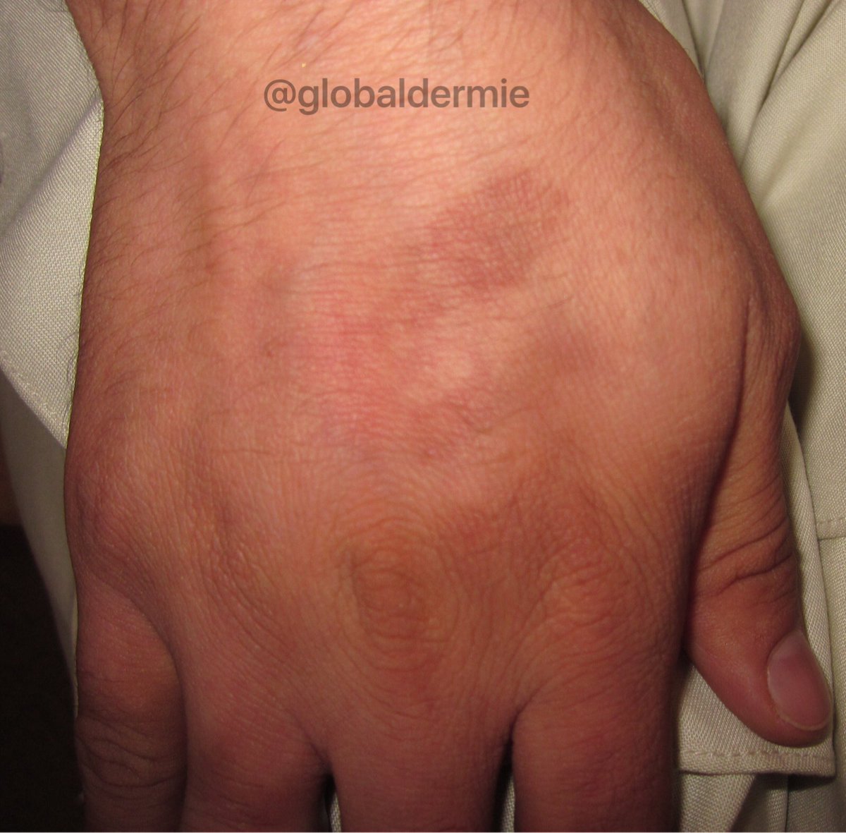 globaldermie's tweet photo. 25M x1wk. "I was outside cutting #lemons to make a juice drink last wk!” #phytophotodermatitis:phototoxic rxn-#furocoumarins+sun #globalderm https://t.co/LoGvIotlIb