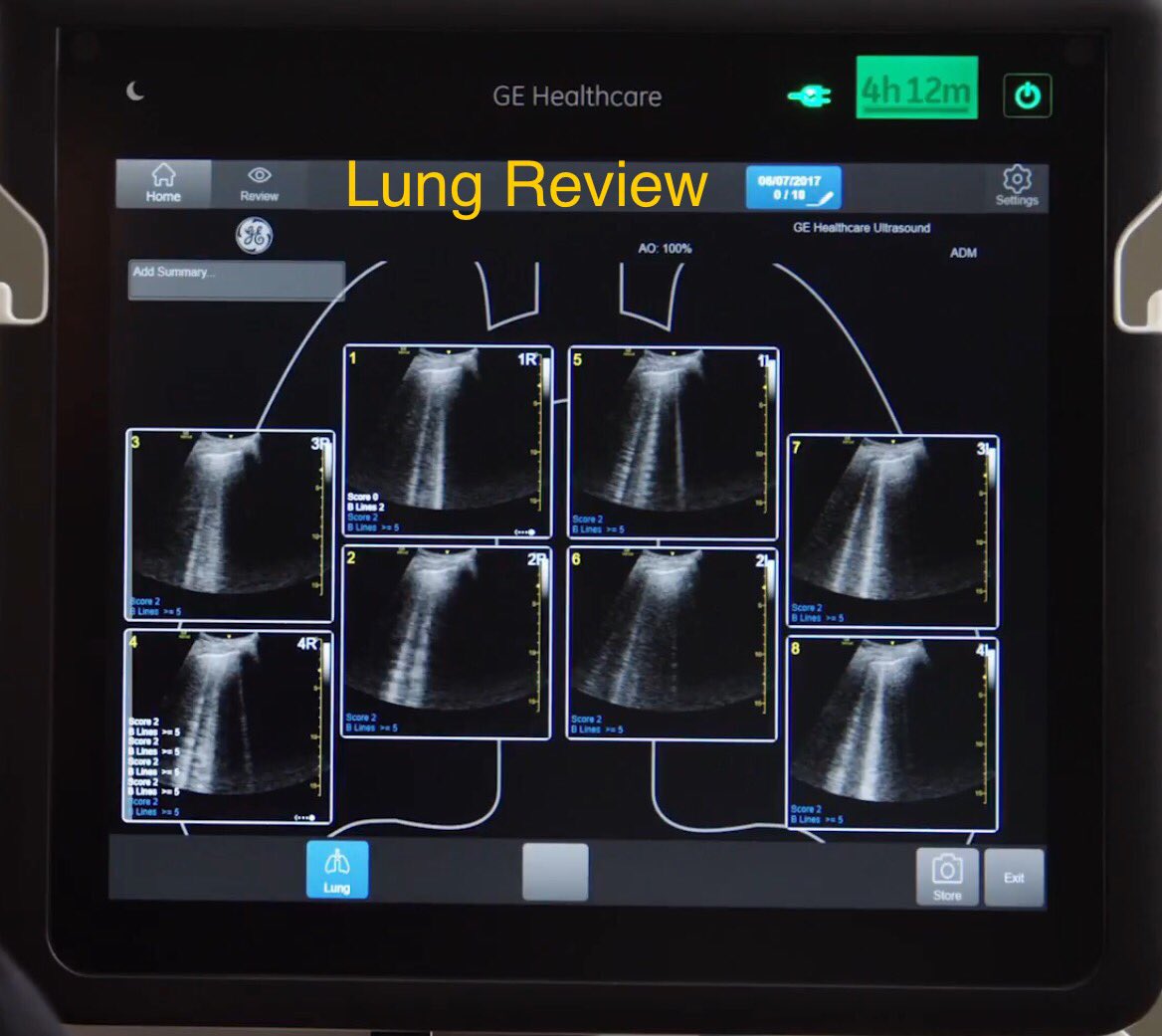 Lisa_Marlowe1's tweet photo. #Lung #POCUS #BLines #autoBLines #GEVenue #shock #EmergencyMedicine #CriticalCare #ShockToolKit #ultrasound
https://t.co/hsJFRPz6Vf https://t.co/bU0OdGpH9B