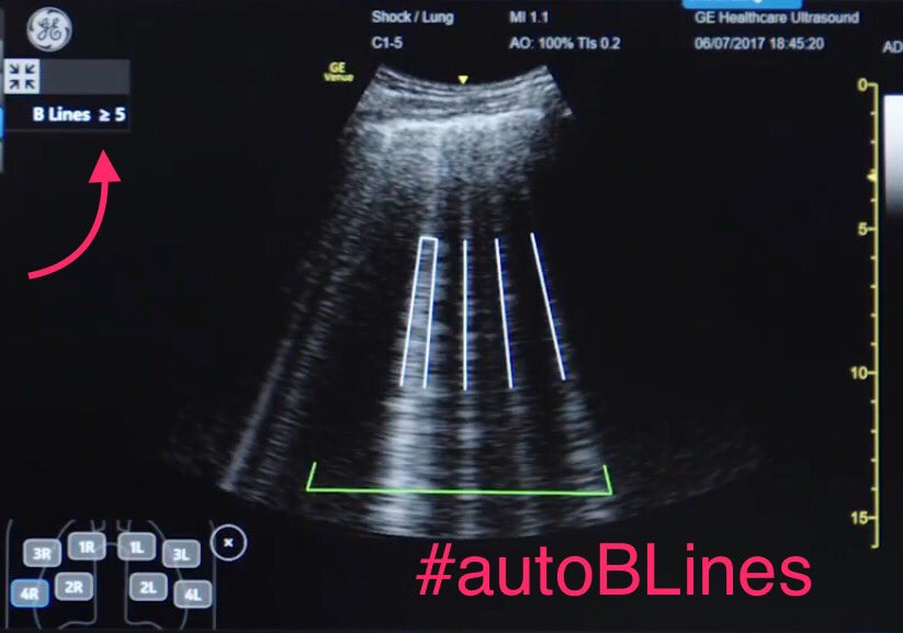 Lisa_Marlowe1's tweet photo. #Lung #POCUS #BLines #autoBLines #GEVenue #shock #EmergencyMedicine #CriticalCare #ShockToolKit #ultrasound
https://t.co/hsJFRPz6Vf https://t.co/bU0OdGpH9B