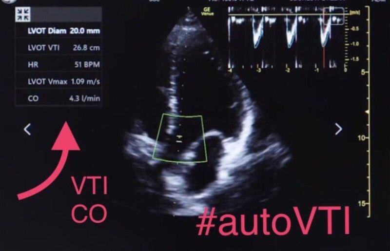 Lisa_Marlowe1's tweet photo. #GEVenue #POCUS #shock #emergencymedicine #criticalcare #cardiac #VTI #cardiacoutput #autoVTI #VTItrending
https://t.co/Z0okECvpst https://t.co/T32azXduNj