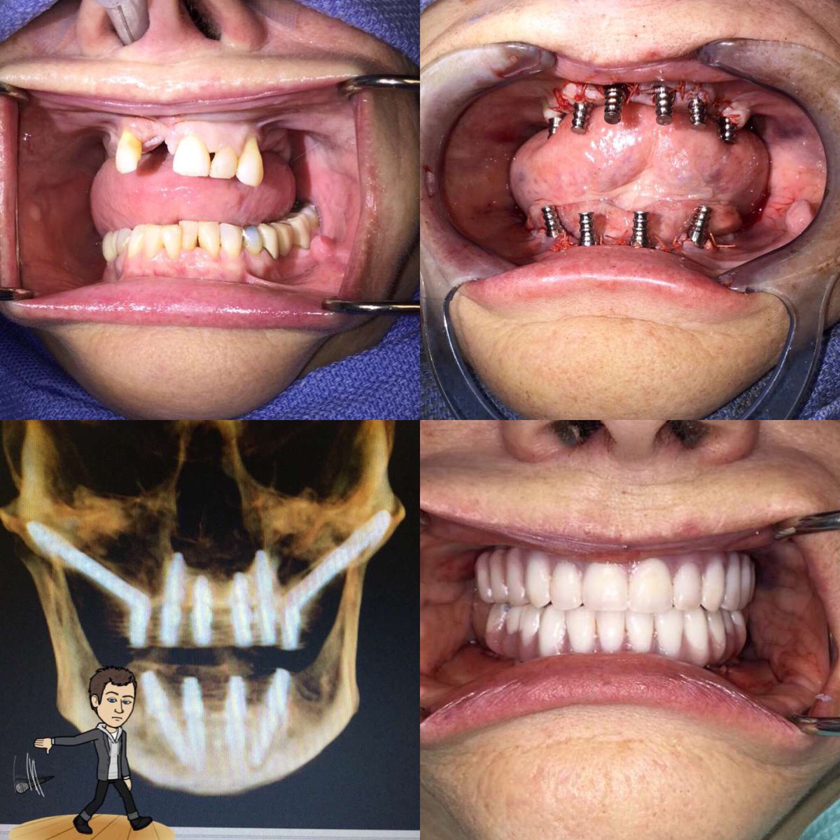 kirkpatrick68's tweet photo. #oneday #zygomaticimplants #therealfacedoc #surgery #oralsurgery #maxillofacialsurgery #trauma #implants #dentistry #newteethnow #cosmetics https://t.co/740lNQ9sIN