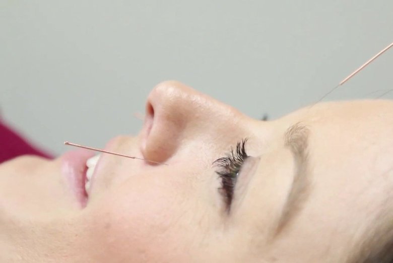 acupuncturecbd's tweet photo. How Acupuncture Works: Acupuncture involves stimulating body walls to produce therapeutic effect. #acupuncture https://t.co/Nn8OnRSbkA https://t.co/Ds2Fh2lguZ