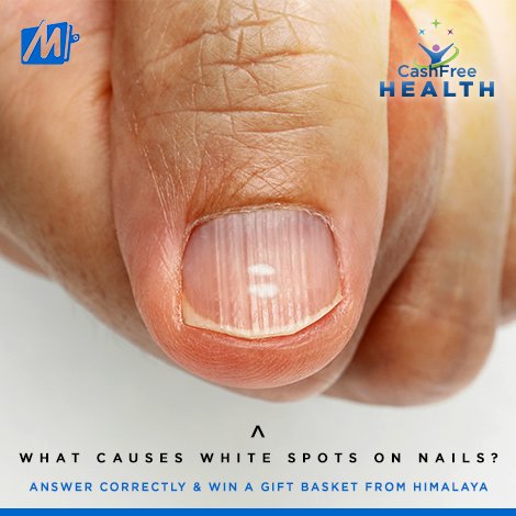 A Look At Your Nails Can Tell If You Have A Life Threatening Disease!