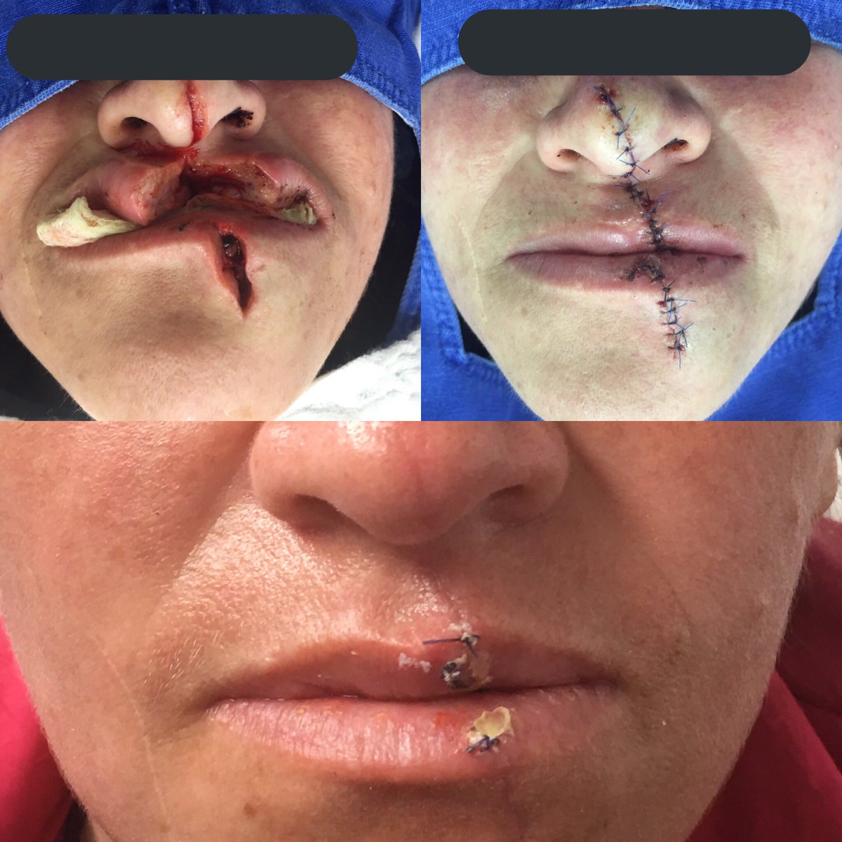 julianrogu's tweet photo. Reconstrucción de labio @MarthaYoRuiz @DR_ALEJODENIZ @USSSantaClara @SubRedCentroOri @Bogota https://t.co/Kh2Yeg0DxN