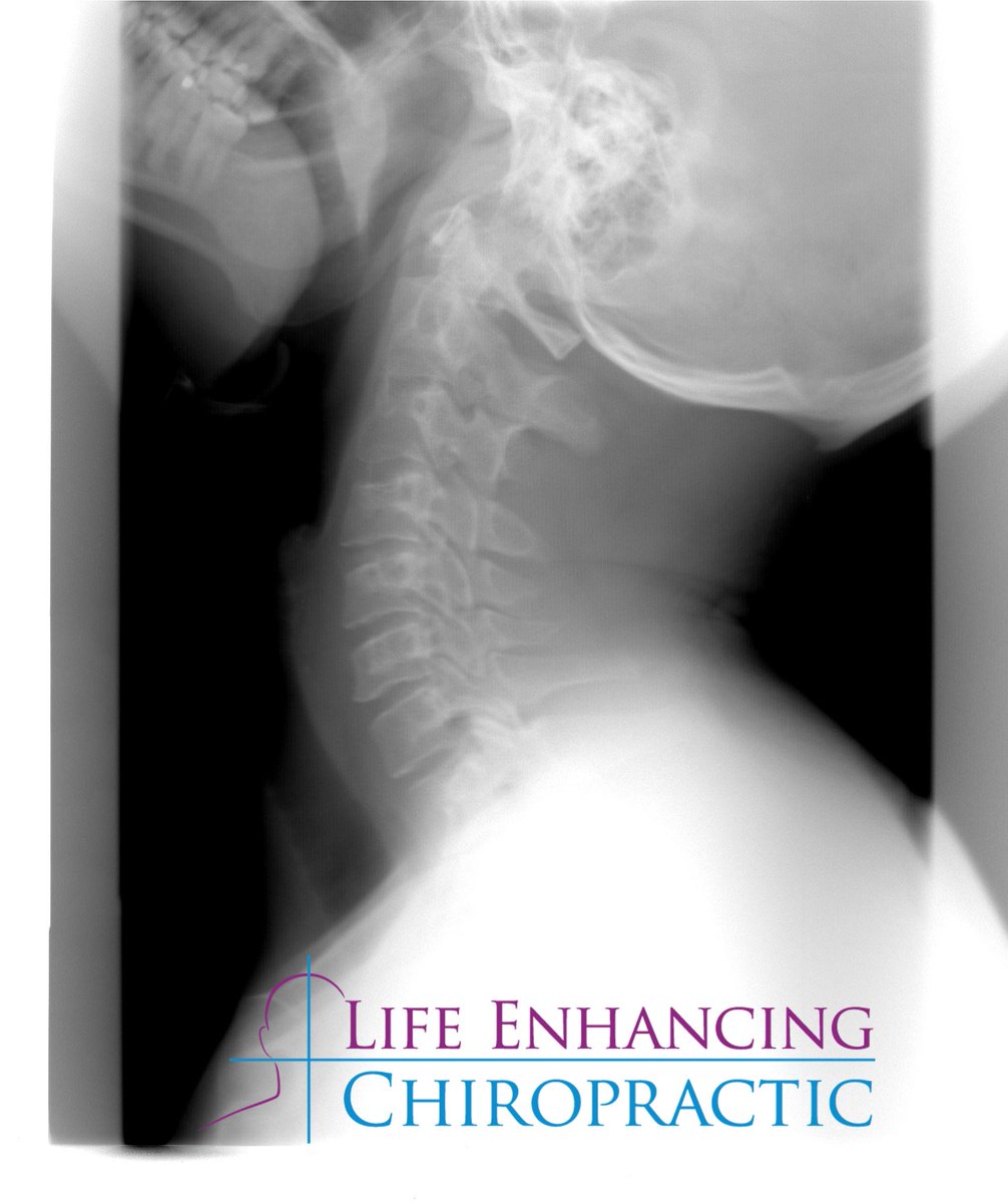 ChiroEnhancing's tweet image. Suffer from #migraine #Vertigo #BackPain #Sciatica #depression ? NUCCA #Chiropractic Can help permanently improve your quality of life
