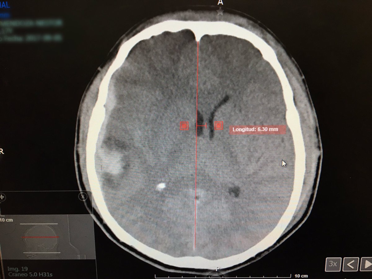 traumabrainmex's tweet photo. #TBI #subduralhematoma #brainedema #Neurosurgery tac ingreso UR, tac control 24 hrs,@Neuro_Skeptic https://t.co/ERf2tK6Gk0