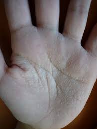 vivelesSVT's tweet photo. "keratodermie palmoplantaire aquagénique, aquadynie, prurit aquagénique idiopathique ..." On apprend on apprend à #MerEduc17 🏥 https://t.co/wphJMvOFgl