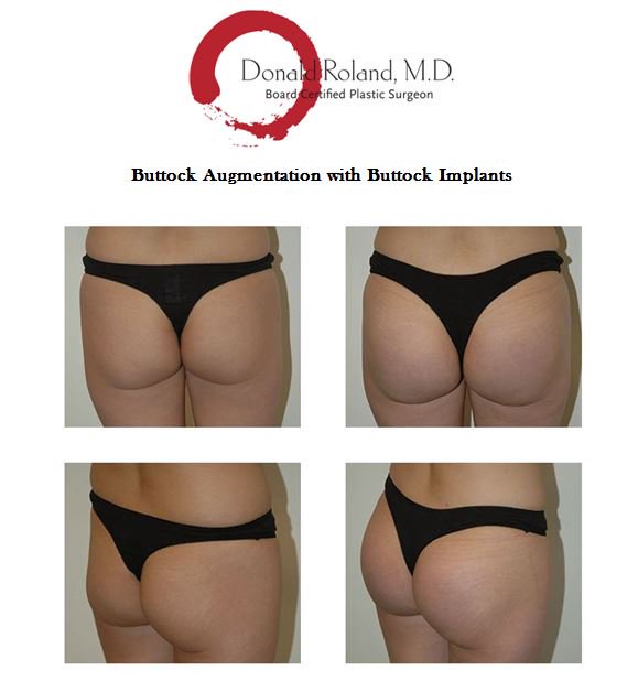 DRolandMD's tweet photo. Buttock Augmentation with Implants - Before and After #buttaugmentation #buttockimplants #nycbuttockaugmentation #nycplasticsurgery #surgery https://t.co/wBj2MoidqY